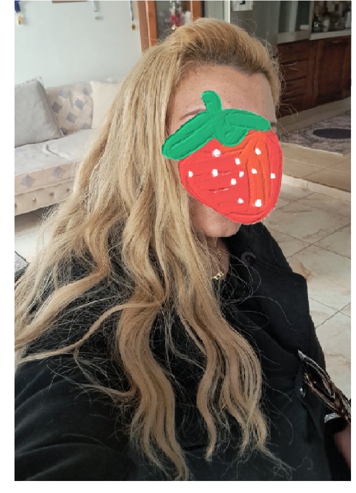 customer-topper-hairloss Γυναικείο Topper Τουπέ κορυφής μαλλιών με κλιπ μεγάλης επιφάνειας -  Μελί /Σκούρο ξανθό 22 inches - Image 3